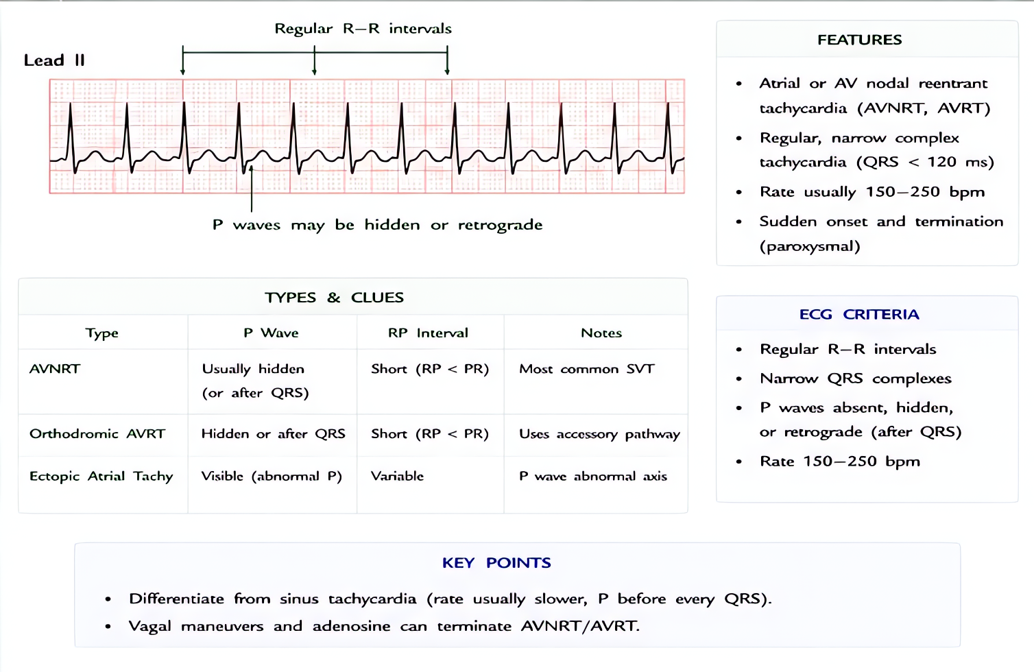 Supraventricular tachycardia (SVT) is regular narrow-complex tachycardia ~150-250 bpm without visible P waves; types include AVNRT and AVRT; treat with vagal maneuvers, adenosine 6 mg IV push, then 12