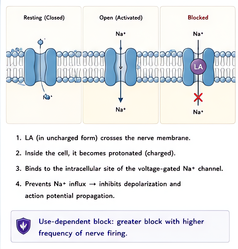 Local anesthetic mechanism - sodium channel block: LAs bind inactivated Na channel from intracellular side, blocking Na influx and preventing depolarization; use-dependent block; small/myelinated fibe