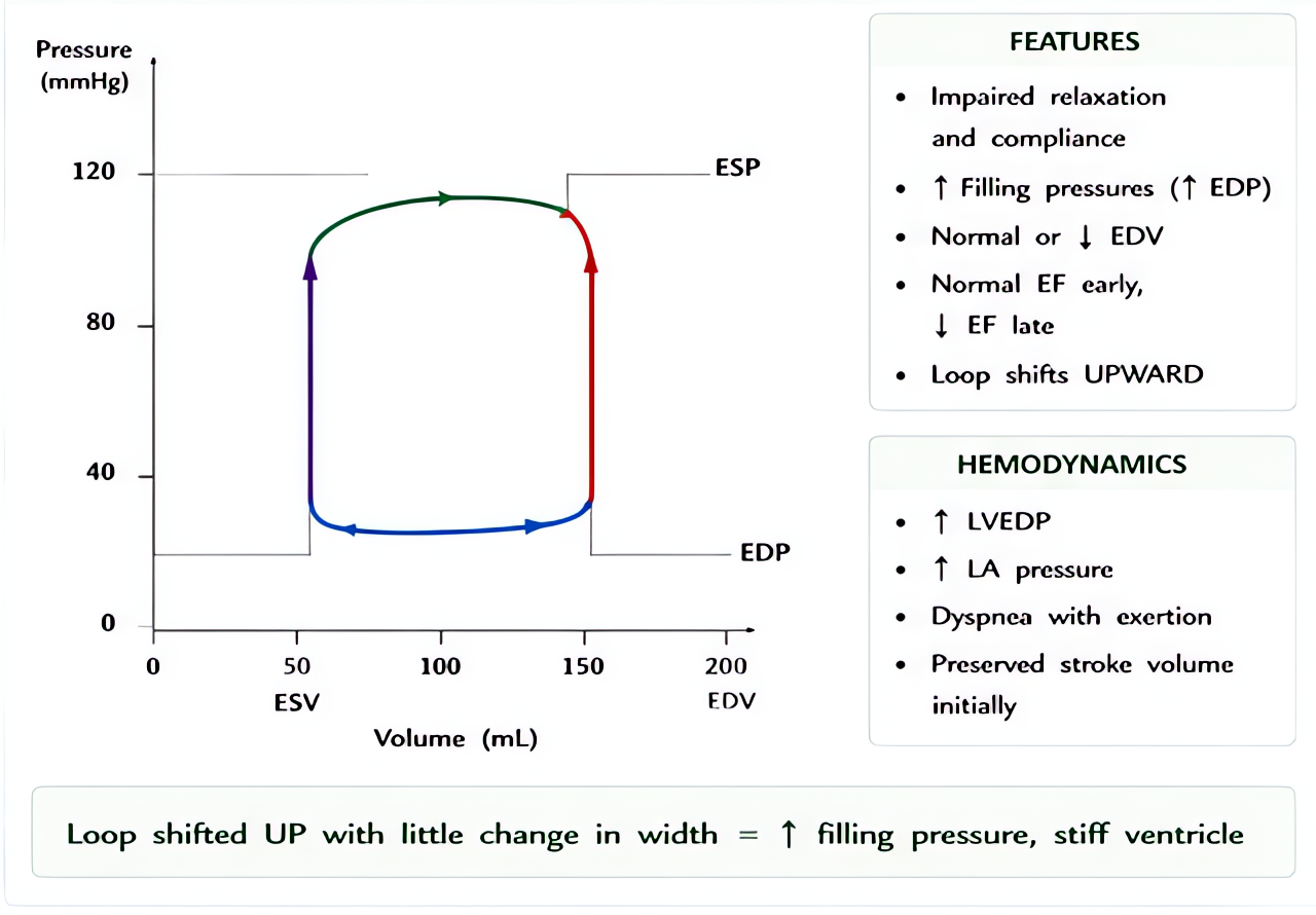 Diastolic dysfunction PV loop (stiff ventricle): upward shift of EDPVR; small loop change with filling pressures, preserved EF but impaired relaxation - HFpEF physiology.