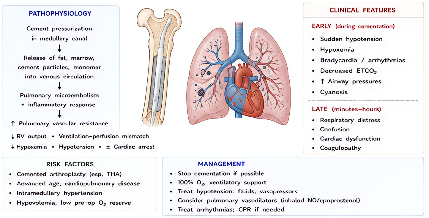 Cement implantation syndrome (CIS) occurs during PMMA cementing in hip arthroplasty; manifests as hypoxia, hypotension, arrhythmia, cardiac arrest from emboli and cement monomer release. Risk in elder