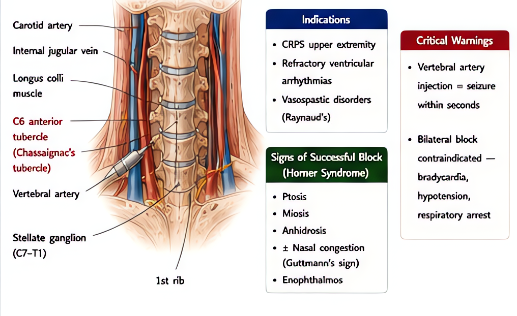 Stellate ganglion block: cervical sympathetic block (C6-C7) for upper extremity sympathetic-mediated pain (CRPS), Raynaud's, ventricular storm. Success signs: Horner's syndrome (ptosis, miosis, anhidr