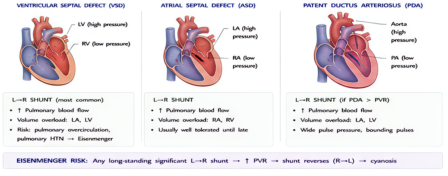Common shunt lesions physiology: VSD, ASD, and PDA produce left-to-right shunts with pulmonary overcirculation; chronic flow leads to pulmonary vascular disease and possible Eisenmenger reversal to ri