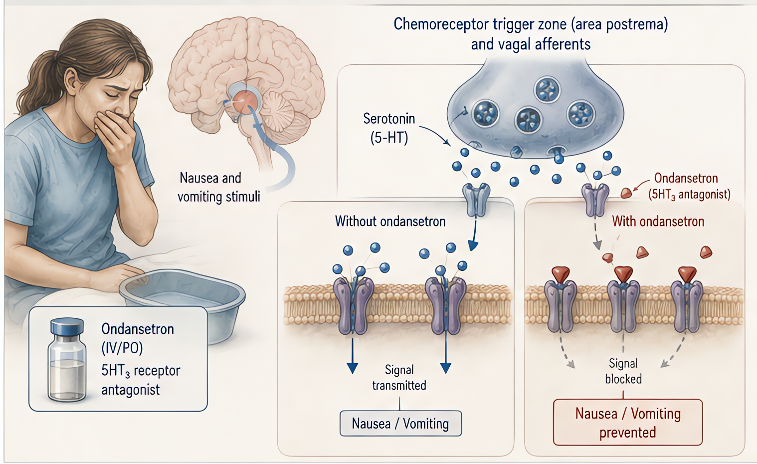 Ondansetron 5HT3 antagonism blocks serotonin at CTZ (area postrema) and vagal afferents; first-line PONV prophylaxis 4 mg IV; minimal sedation; risk of QT prolongation - avoid with congenital long QT.
