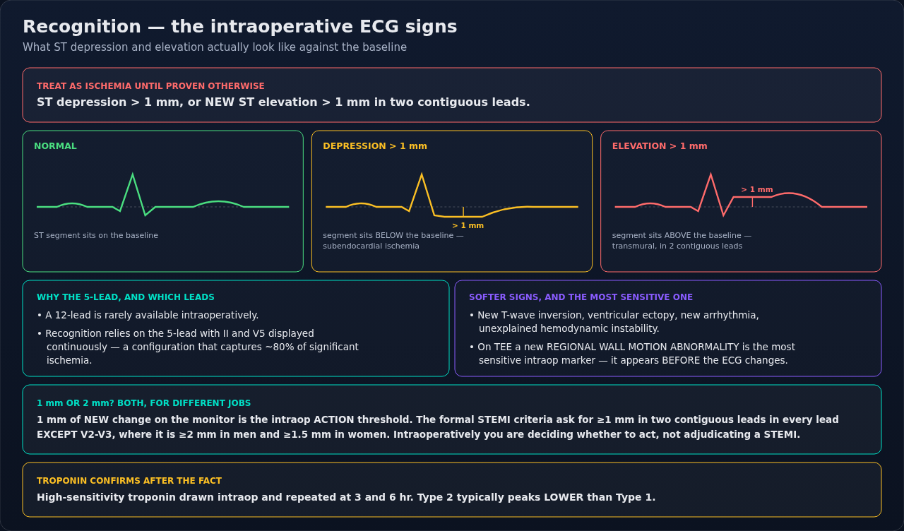 How intraoperative ischemia is recognized — the ECG changes, the softer signs, and the TEE finding. It also keeps the intraoperative action threshold separate from the formal STEMI criteria, which are