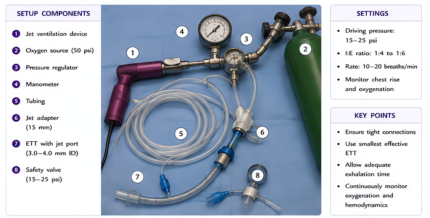 Jet ventilation setup with O2 source, pressure regulator (15-25 psi adult, 5-10 peds), manometer, tubing, jet injector, and ETT/cricothyrotomy port; contraindicated in severe obstructive lung disease