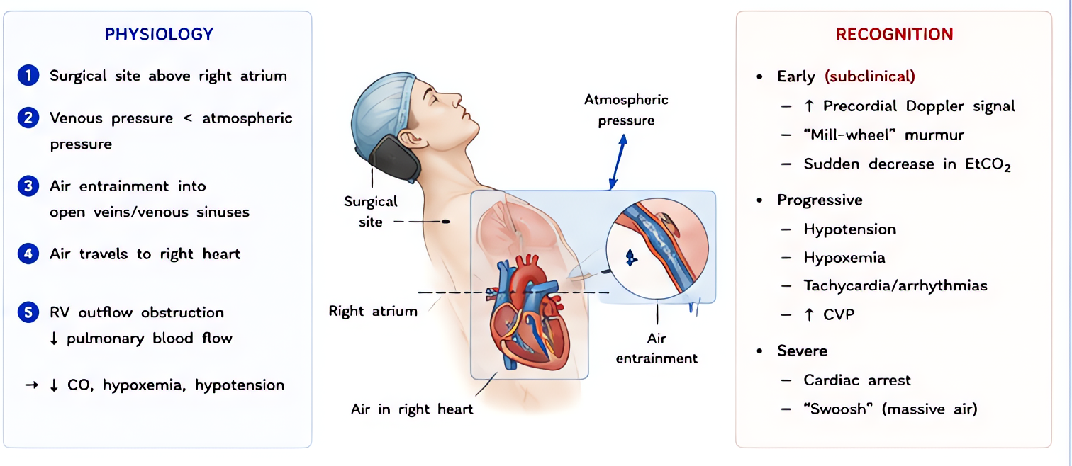 Venous air embolism (VAE) physiology and recognition: air entrained via open noncollapsible veins above heart; signs include sudden ETCO2 drop, hypoxia, hypotension, mill-wheel murmur, ST changes.
