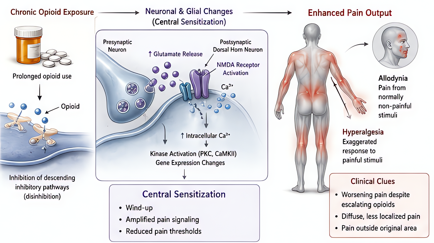 Opioid-induced hyperalgesia (OIH): paradoxical increased pain sensitivity from chronic/high-dose opioids via NMDA receptor sensitization and glial activation; treat with opioid rotation, ketamine, mul